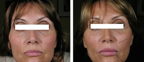 filler acido ialuronico viso