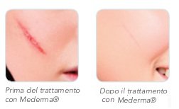 mederma