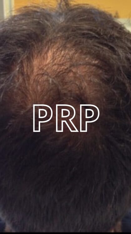 prp capelli milano