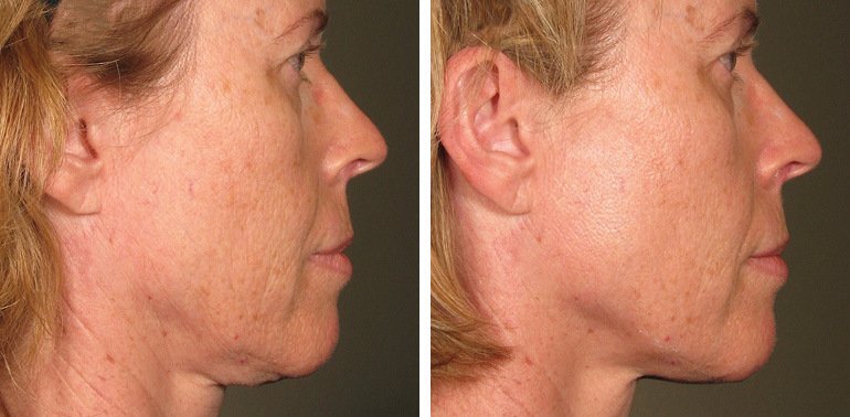 before after ultherapy results full face 15