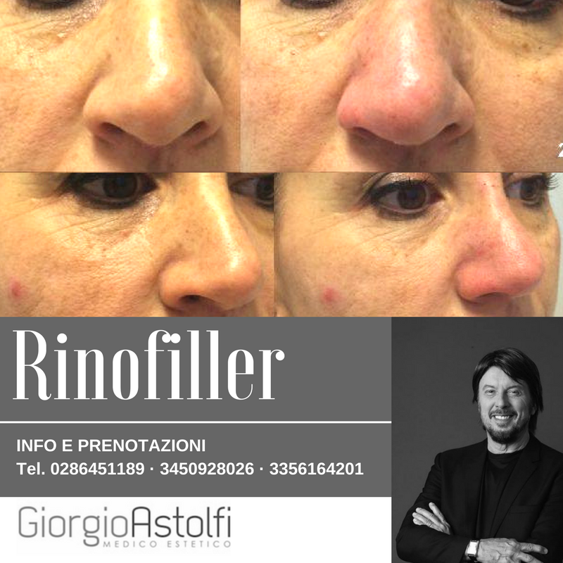 rinofiller